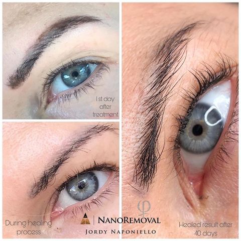 nanoremoval détatouage sans laser