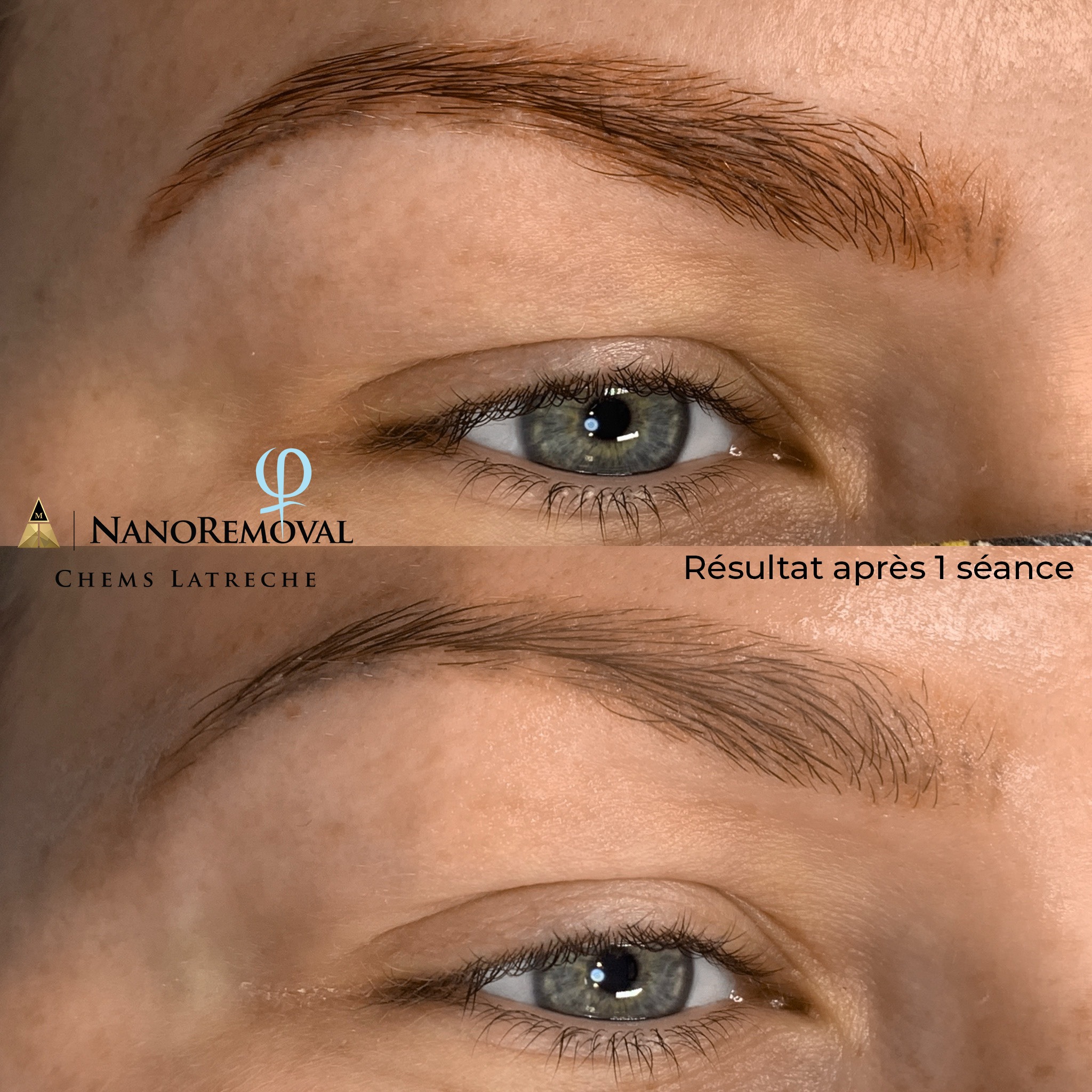 nanoremoval détatouage sans laser
